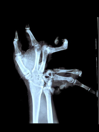 explosive hand xray by surfacant