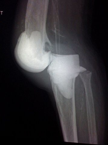 Knee dislocation via EckesRaie on Flickr
