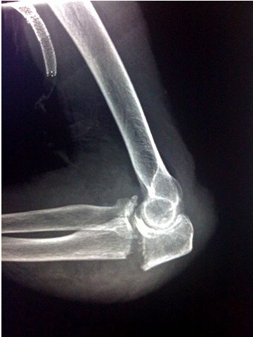 Smashed elbow via EckesRaie on Flickr