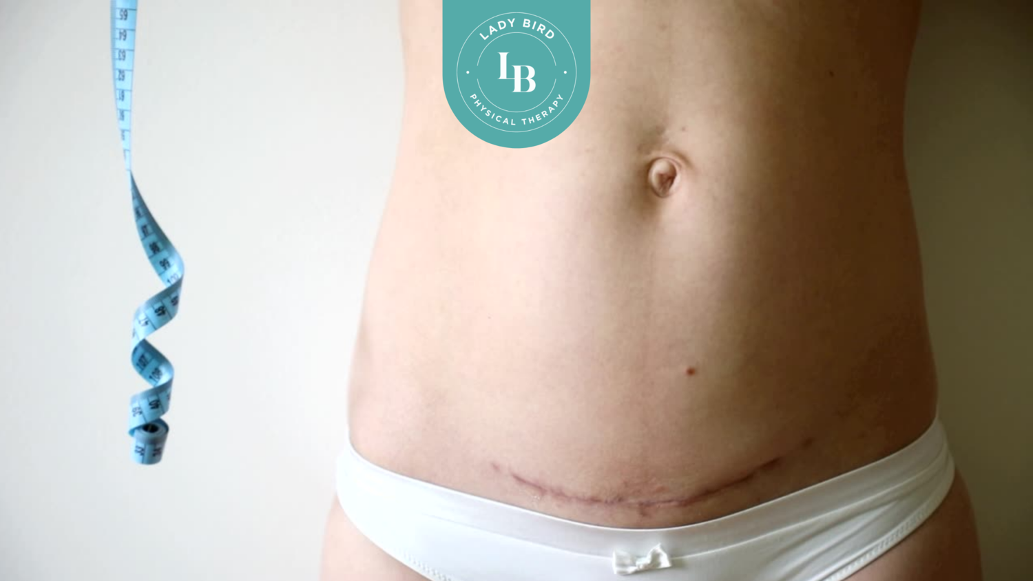 Is it safe to laser over a C-section scar? 