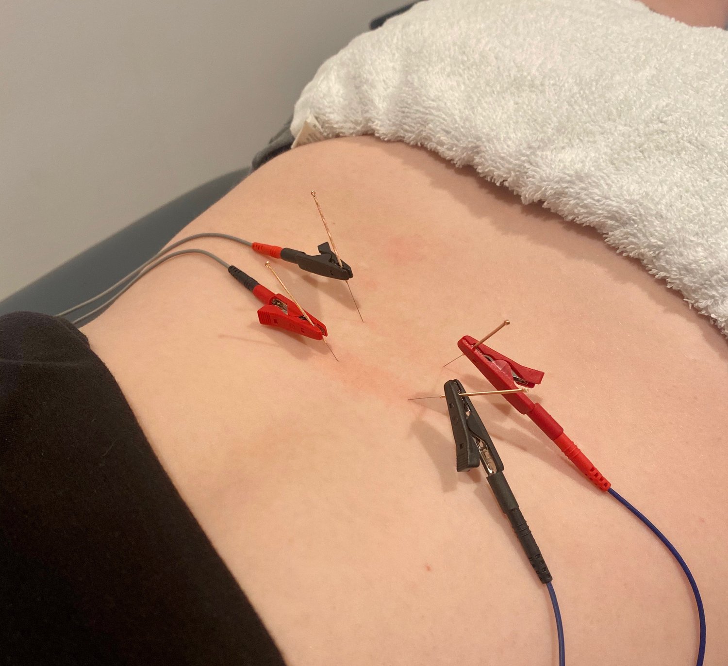 Dry Needling Electrical Stimulation (E-Stim) Treatment with Motion to  Manage Foot Pain 