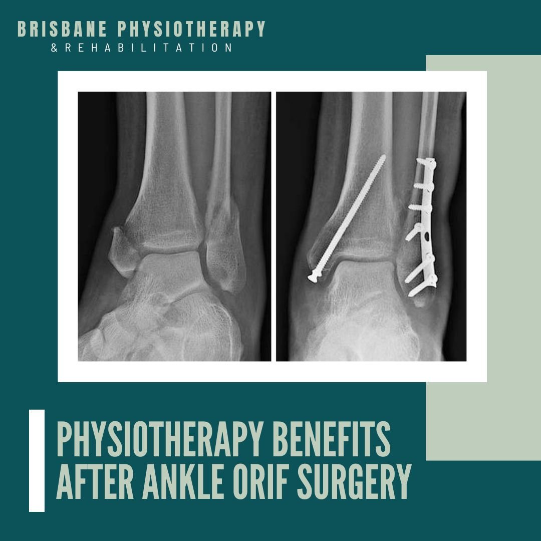 Physiotherapy Benefits after Ankle ORIF Surgery - Brisbane