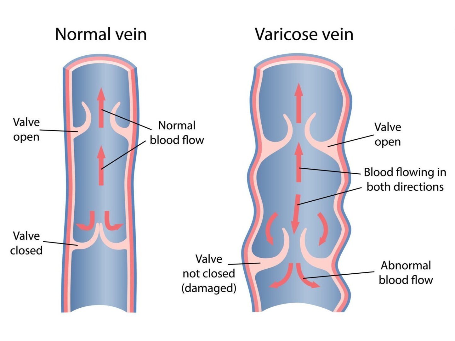 Varicose Veins  The Foundation to Advance Vascular Cures
