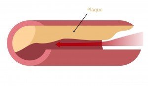Plaque Artery