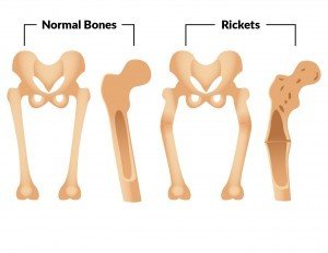 Bone Structure and Rickets