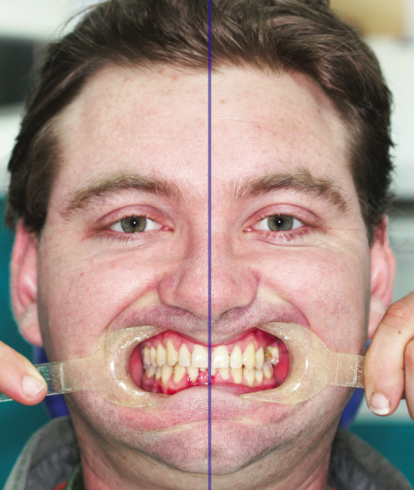 Dental Midline Comparison