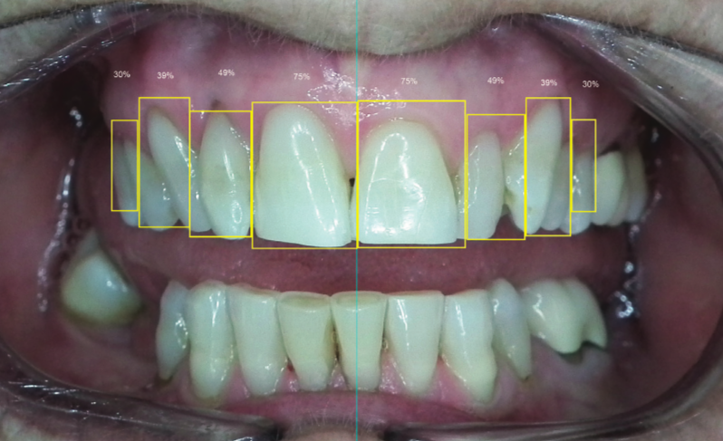 Ideal Tooth Proportion