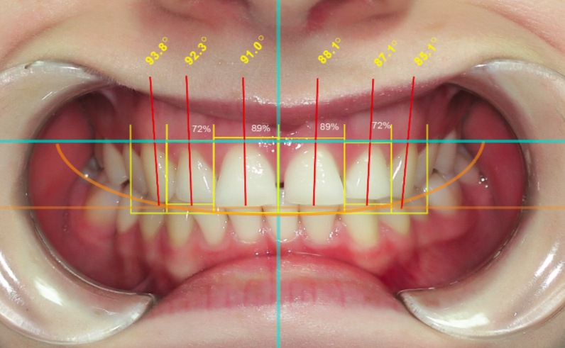 Composite Dental Analysis