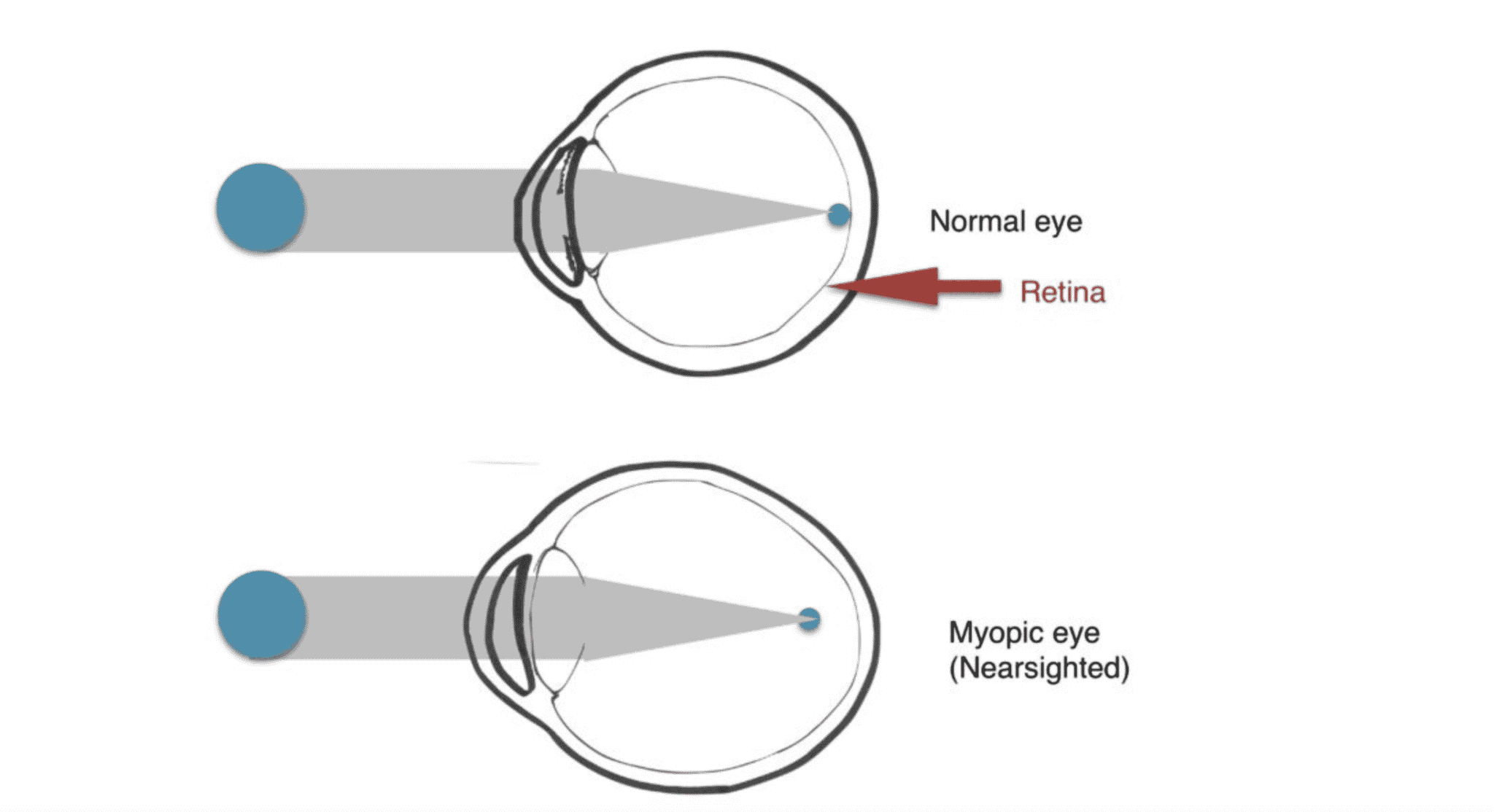 schematic drawing by pediatric ophthalmologist Dr. Rupa Wong of what a myopic eye looks like. 
