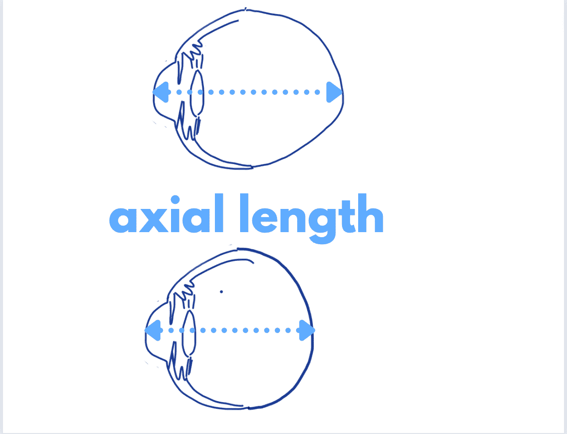 drawing by eye doctor showing problems with axial elongation and myopia management in hawaii