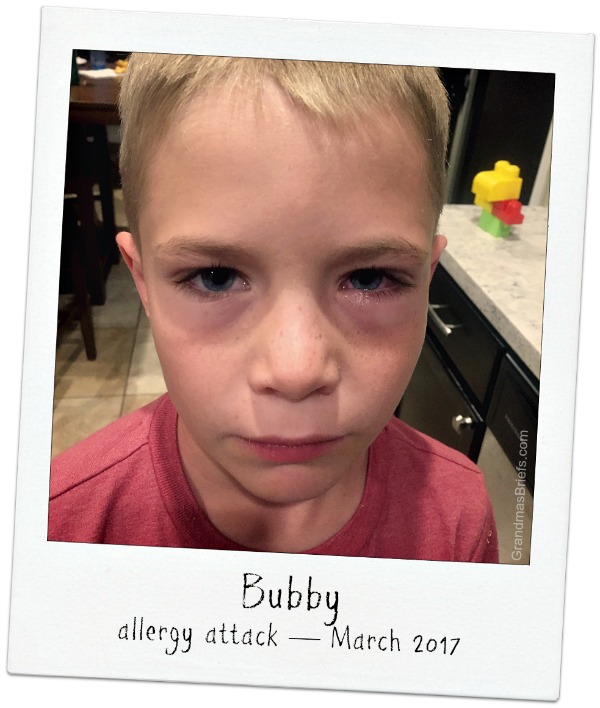 boy with allergies