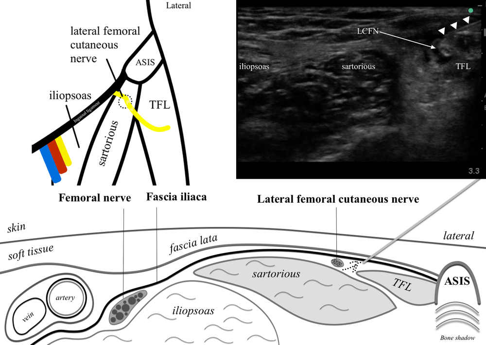 Lateral femoral cutaneous block — Highland EM Ultrasound Fueled pain