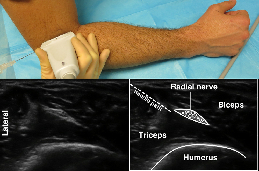 Forearm blocks — Highland EM Ultrasound Fueled pain management