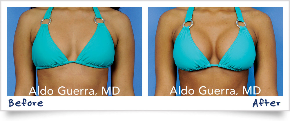 Breast Augmentation Before & After Photos 117