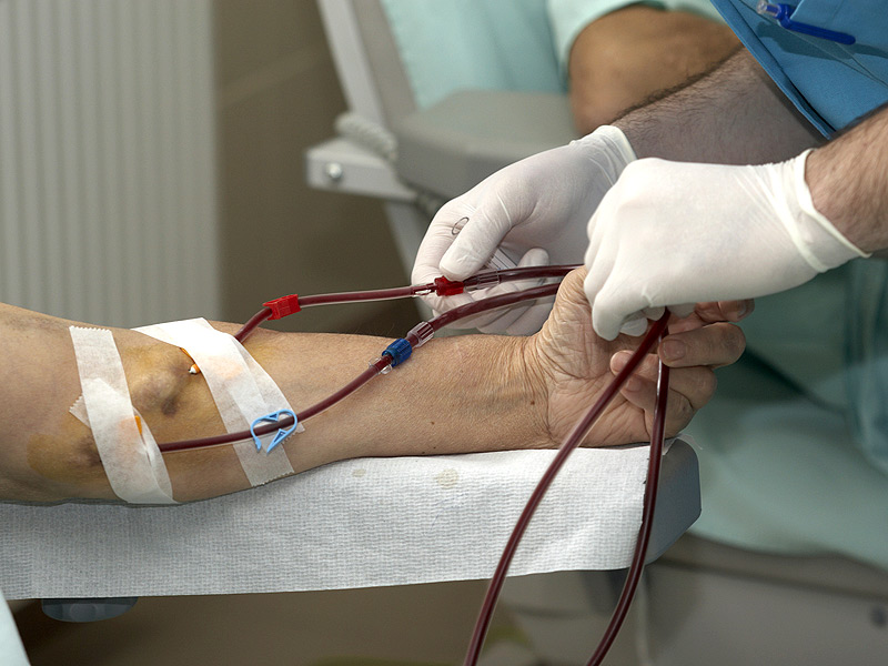 Is Peritoneal Dialysis Safer Than Hemodialysis