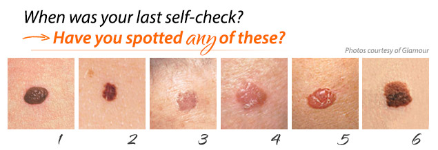 Mole or Melanoma? Tell-Tale Signs in Benign Nevi and ...