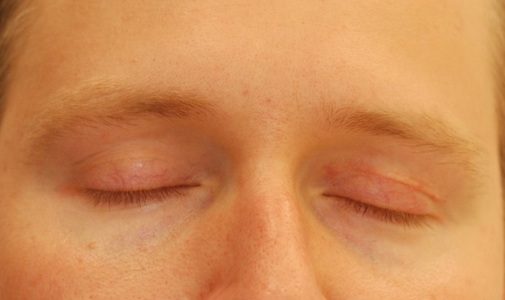 What do scars after eyelift (blepharoplasty) look like ...