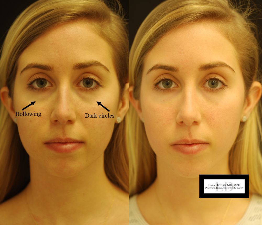 Tear Trough Under Eye Filler Before And After - All You Need Infos