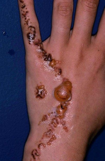 Allergie voor henna - Huidarts.com