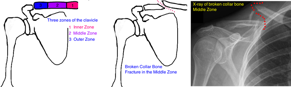 Broken Collar Bone (Clavicle Fracture) — Bone Talks