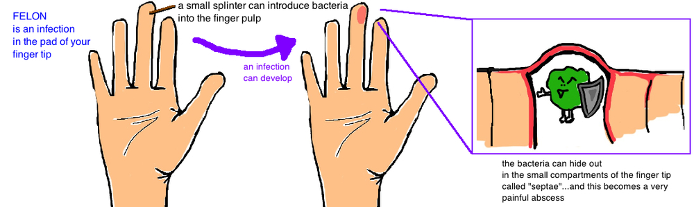 Finger Infection Topic Guide - eMedicineHealth