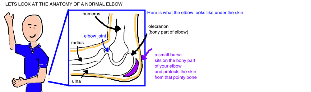 Elbow Bursitis (Swollen Elbow) — Bone Talks