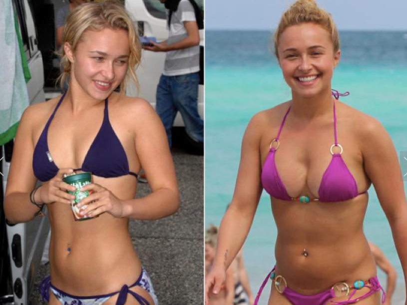 Breast Augmentation Before And After Celebrity Edition