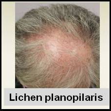 Alopecia areata treatment steroids
