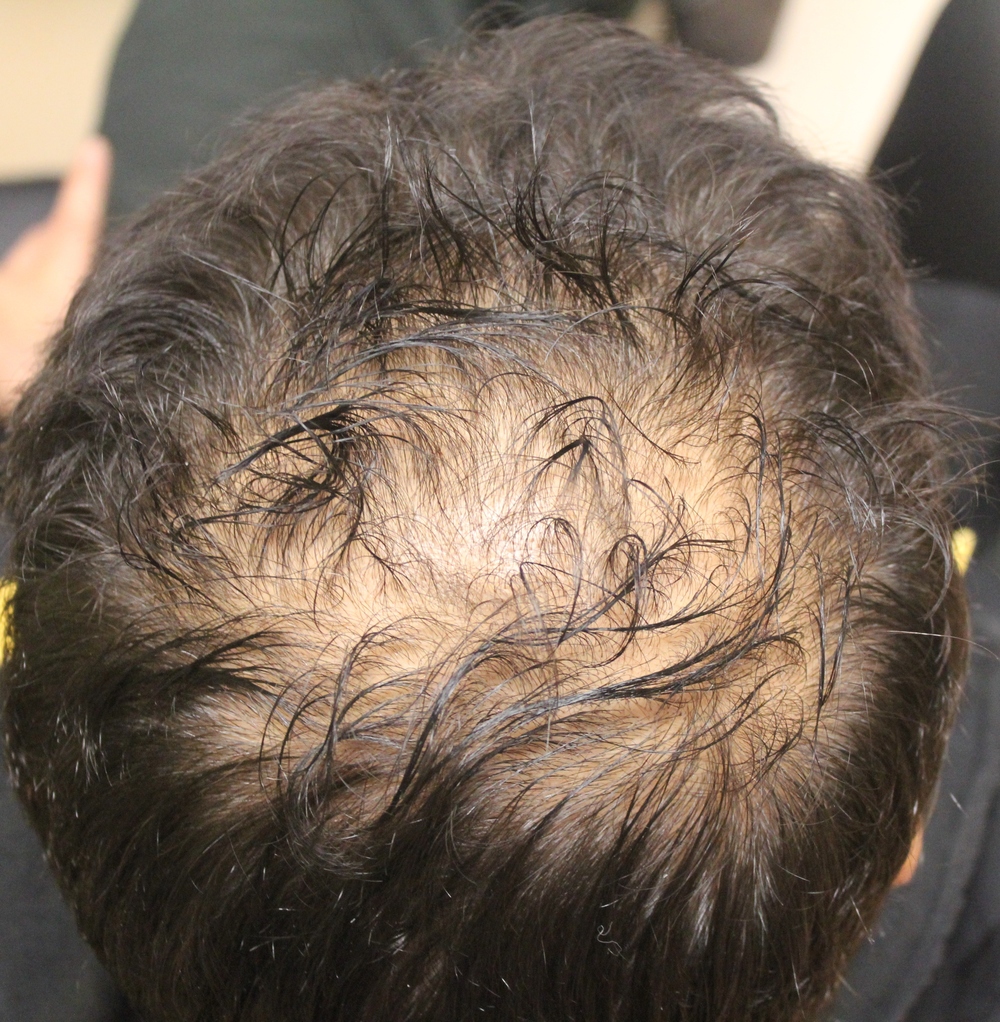 Flutamide for AA in women  Hair restoration Alexandria 