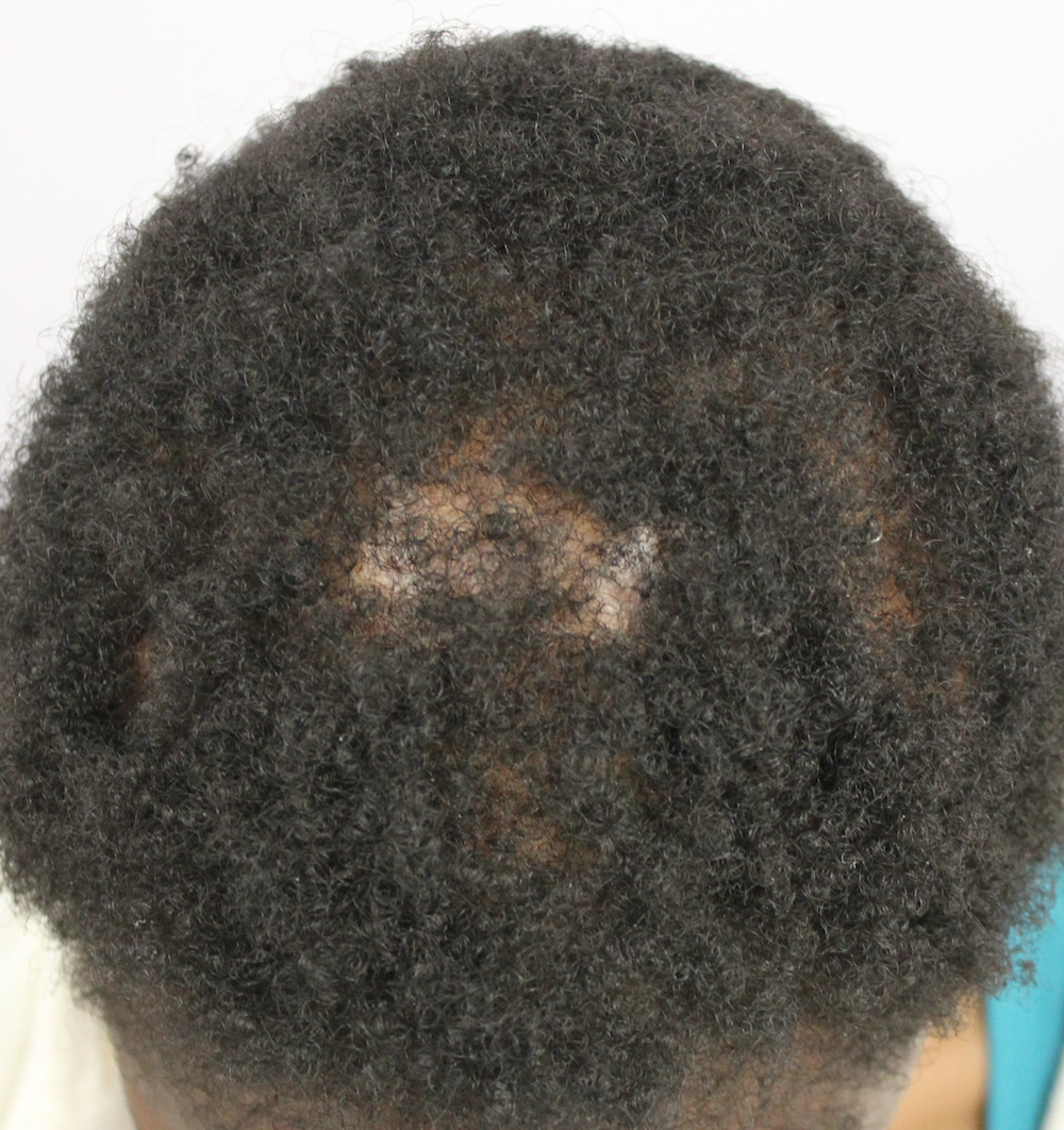 Differentiating Central Centrifugal Cicatricial Alopecia ...