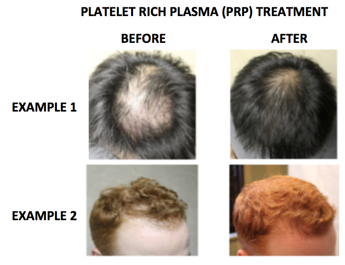 Platelet rich plasma PRP for the treatment of genetic hair loss 