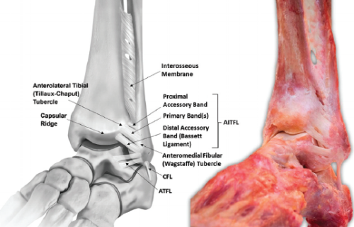 Anatomy 101: Ankle Syndesmosis - Distal Tibiofibular Joint ...