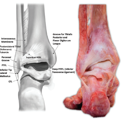 Anatomy 101: Ankle Syndesmosis - Distal Tibiofibular Joint — Rayner & Smale