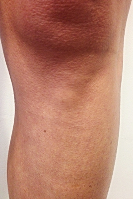 Saggy Knees 7 Days Later Post Tightening — Harpal Clinic