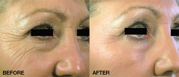 SKin Revitalization Treatment with the Palomar Icon Laser 
