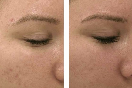  Before & After: Automated Micro-Needling Treatment 