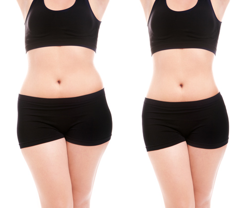  liposuction before & After 
