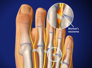 What does a Neuroma look like?&nbsp; 