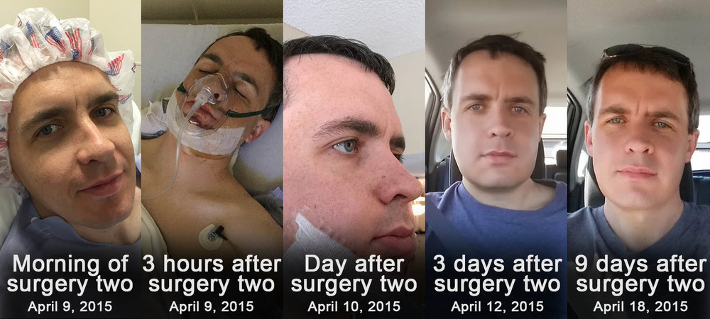 Orthognathic Surgery Jaw Wired Shut Diet