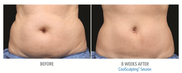 Clarity_CoolSculpting before + after