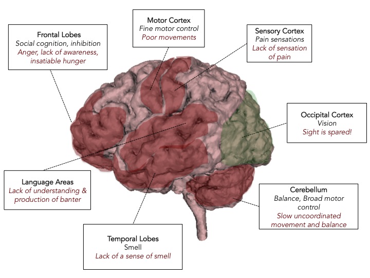 areas afectación cerebro zombie