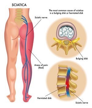 Does Acupuncture Help Sciatica?