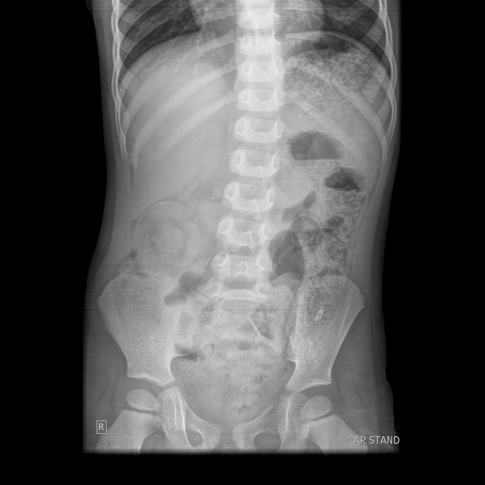 The Abdominal XRay: A relic or a reliable tool? — Taming ...