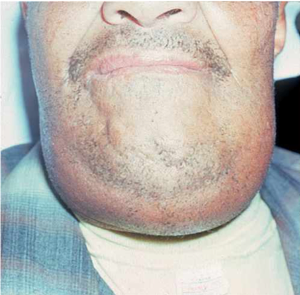 Fig. 2  â€œBrawnyâ€ swelling involving submandibular space typical of Ludwigâ€™s Angina.  [Image from medical-dictionary.thefreedictionary.com/]