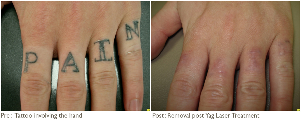 Tattoo removed on fingers showing slight scarring underneath caused by ...