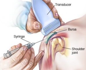 Steroid injection shoulder aftercare