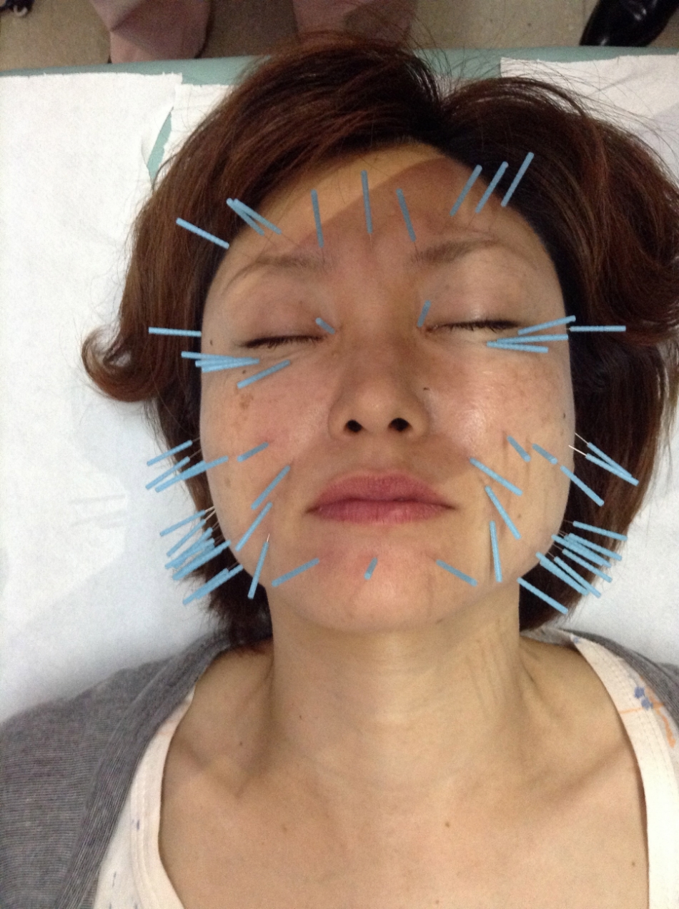 Résultat de recherche d'images pour "kitagawa acupuncture faciale"