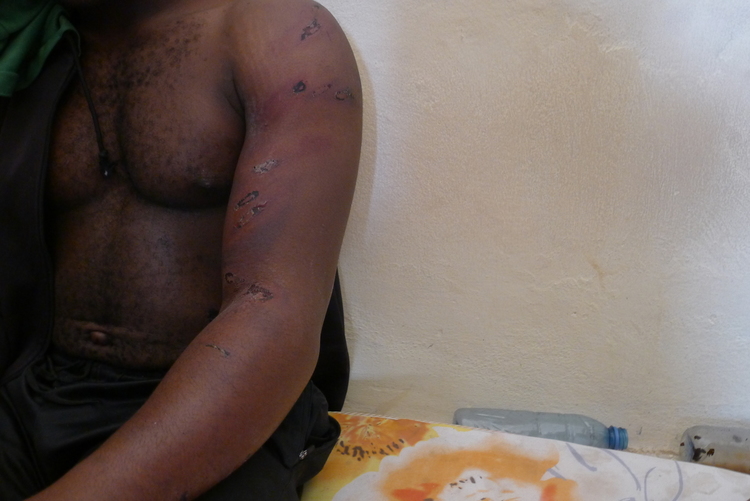 أحد المحتجزين يكشف عن الإصابات التي لحقت به جراء الضرب بعد أربعة أيام فقط في مركز الاحتجاز.
