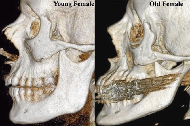 Skeletal changes in the aging face.