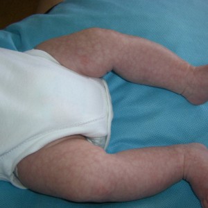 mottled baby infant rash legs sick months under neonatal when undifferentiated outline signs